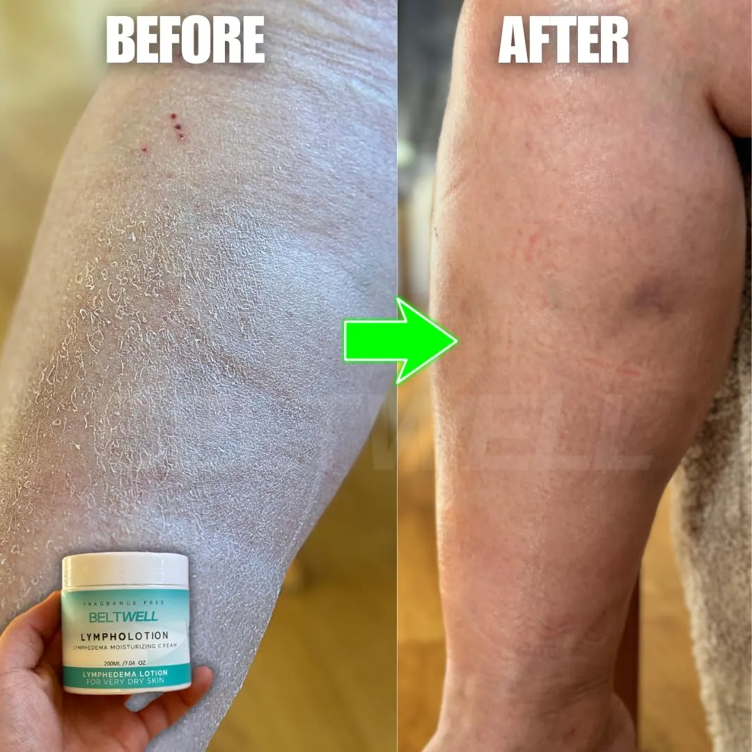 Beltwell® - Fragrance-Free Non-Greasy Lotion For Dry Itchy Skin From Edema, Swelling, Lymphedema, Varicose Veins, Ulcers, Cellulitis